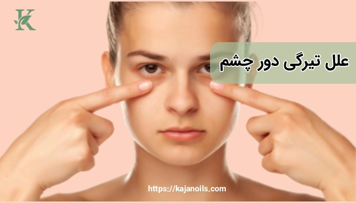علت تیرگی دور چشم