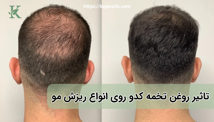 جلوگیری از طاسی مردانه