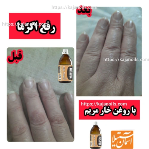 روغن گیاهی برای اگزما