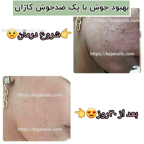 روغن ضد جوش گیاهی