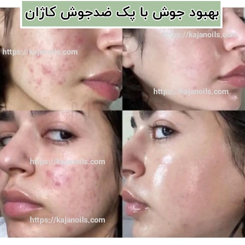 درمان طبیعی جوش صورت