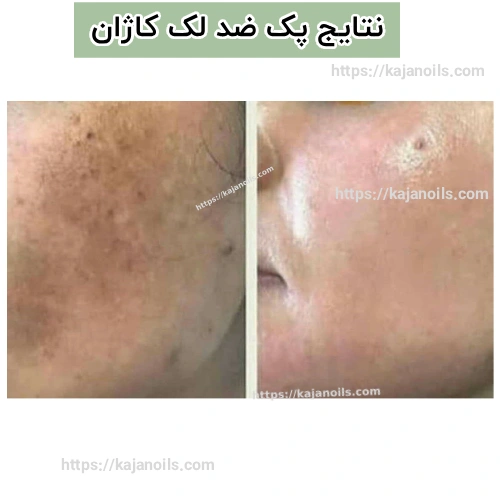 روغن ضدلک گیاهی