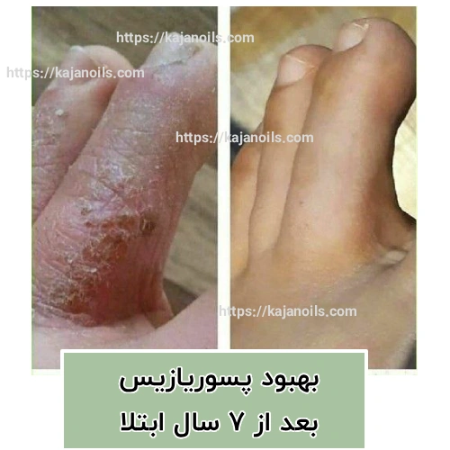 درمان طبیعی پسوریازیس