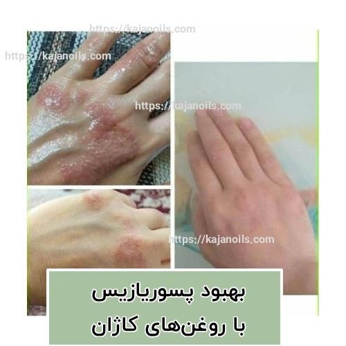 درمان گیاهی پسوریازیس