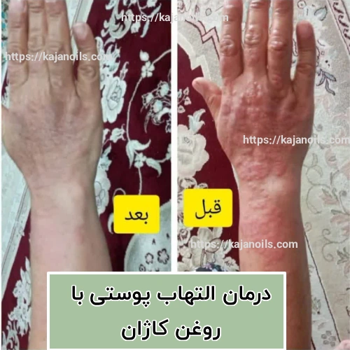 درمان طبیعی التهابات پوستی