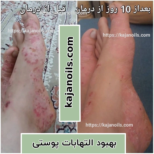 درمان پسوریازیس با روغن