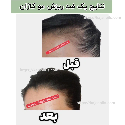 قطع ریزش مو