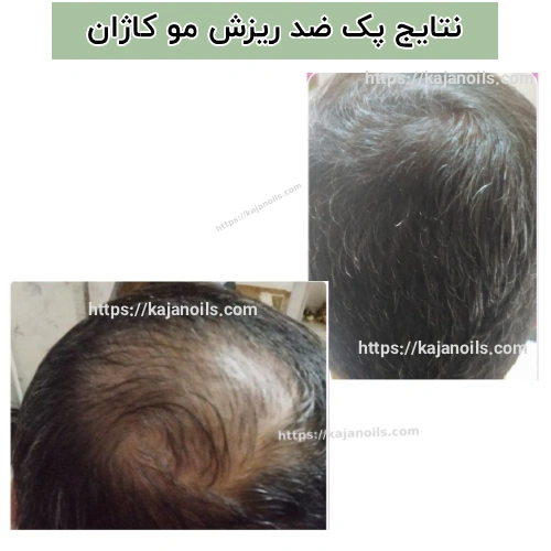 روغن ضد ریزش مو