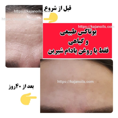 بوتاکس طبیعی پوست
