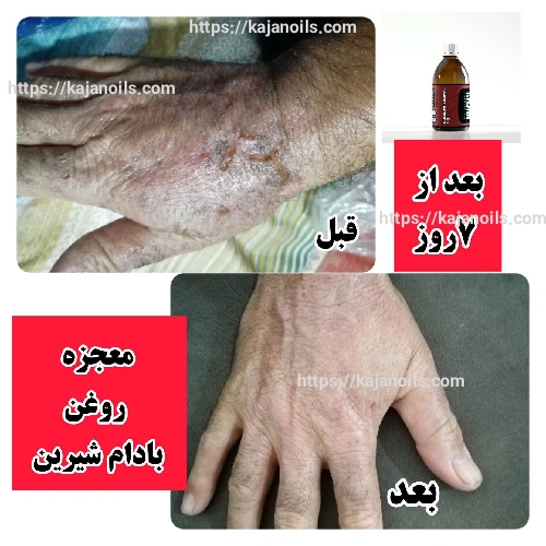 روغن گیاهی برای جای زخم